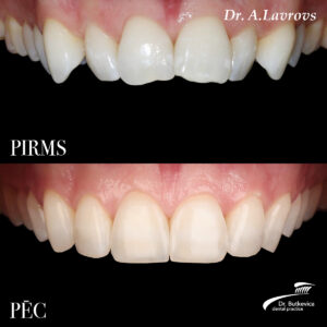 Foto Pirms Pec 01