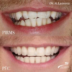 Foto Pirms Pec 03
